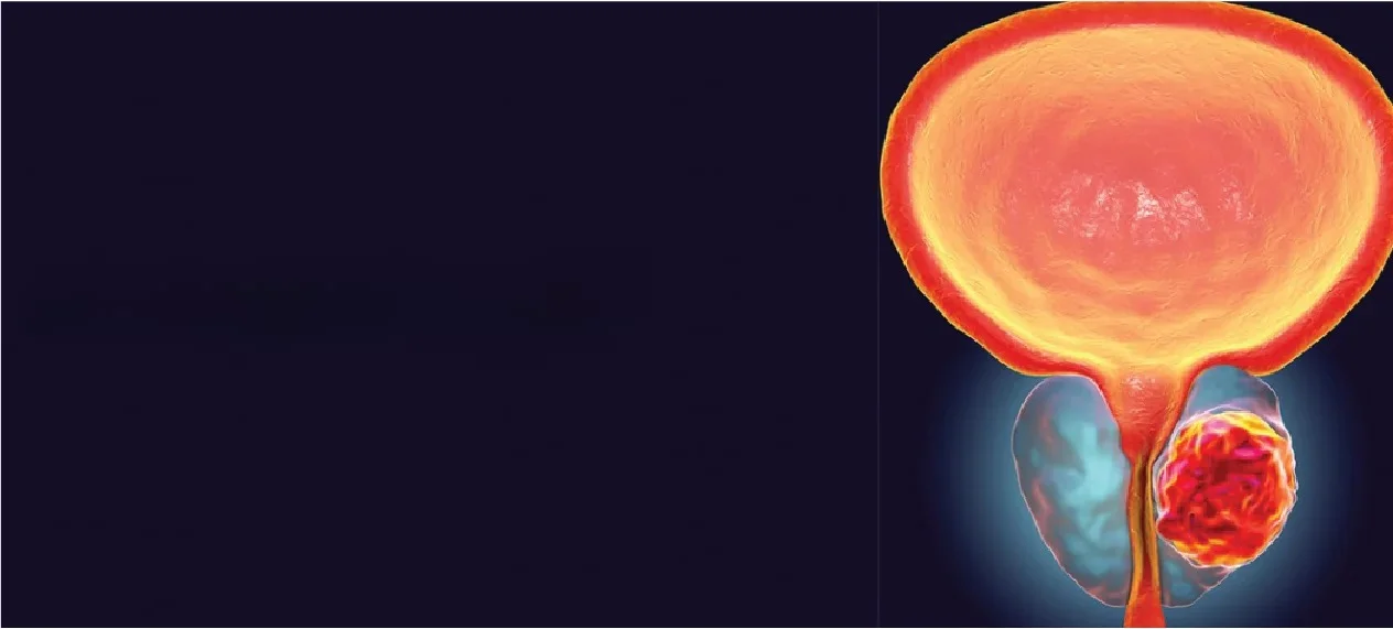 What Are The 5 Warning Signs Of Prostate Cancer?